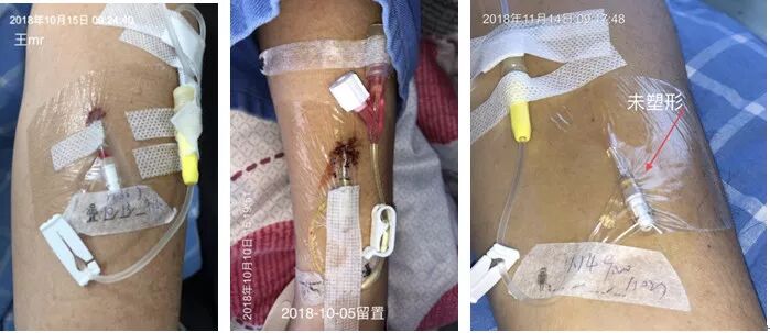 bd留置针怎么使用7大留置针固定要点，操作考试必掌握！_https://www.jmylbn.com_新闻资讯_第8张