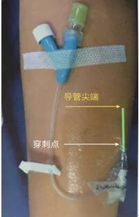 bd留置针怎么使用7大留置针固定要点，操作考试必掌握！_https://www.jmylbn.com_新闻资讯_第19张