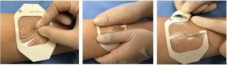 bd留置针怎么使用7大留置针固定要点，操作考试必掌握！_https://www.jmylbn.com_新闻资讯_第11张