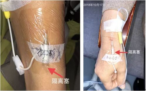 bd留置针怎么使用7大留置针固定要点，操作考试必掌握！_https://www.jmylbn.com_新闻资讯_第13张