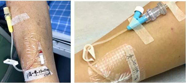 bd留置针怎么使用7大留置针固定要点，操作考试必掌握！_https://www.jmylbn.com_新闻资讯_第15张