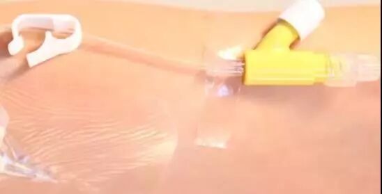 为什么叫正压留置针的留置针堵管了，拔针还是强行冲管？_https://www.jmylbn.com_新闻资讯_第4张