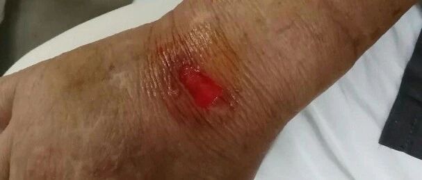 输液贴粘掉3cm×2cm的皮肤，这起医院性损害，转发提醒所有人