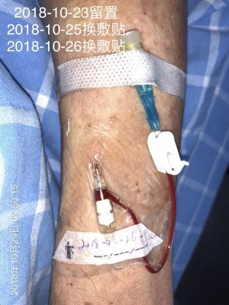 bd留置针怎么使用留置针固定4个要点，最后一个有问题_https://www.jmylbn.com_新闻资讯_第8张