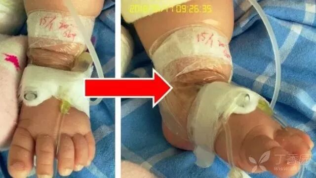 bd留置针怎么使用留置针固定多图详解：必须要U型吗，怎么固定才最合适？_https://www.jmylbn.com_新闻资讯_第25张