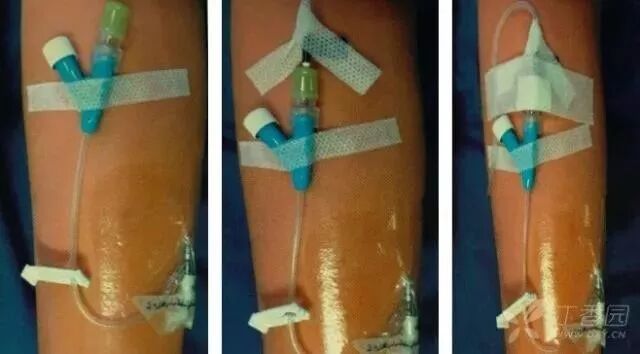 bd留置针怎么使用留置针固定多图详解：必须要U型吗，怎么固定才最合适？_https://www.jmylbn.com_新闻资讯_第7张