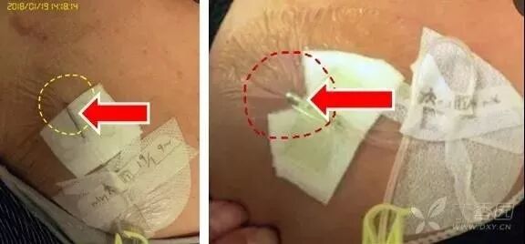 bd留置针怎么使用留置针固定多图详解：必须要U型吗，怎么固定才最合适？_https://www.jmylbn.com_新闻资讯_第23张