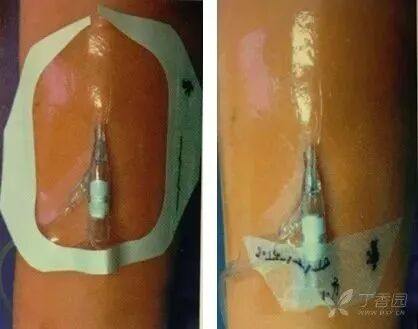 bd留置针怎么使用留置针固定多图详解：必须要U型吗，怎么固定才最合适？_https://www.jmylbn.com_新闻资讯_第5张
