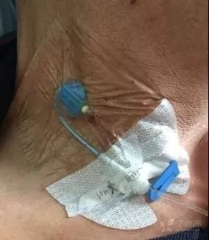 bd留置针怎么使用留置针固定多图详解：必须要U型吗，怎么固定才最合适？_https://www.jmylbn.com_新闻资讯_第19张