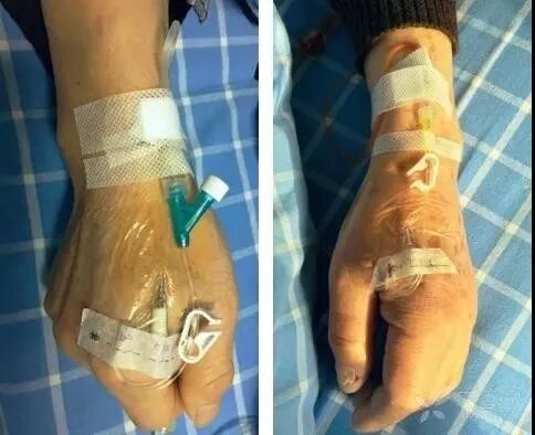 bd留置针怎么使用留置针固定多图详解：必须要U型吗，怎么固定才最合适？_https://www.jmylbn.com_新闻资讯_第9张