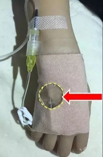 bd留置针怎么使用留置针固定多图详解：必须要U型吗，怎么固定才最合适？_https://www.jmylbn.com_新闻资讯_第27张