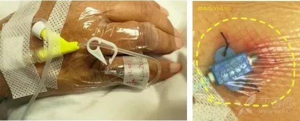 bd留置针怎么使用留置针固定多图详解：必须要U型吗，怎么固定才最合适？_https://www.jmylbn.com_新闻资讯_第13张