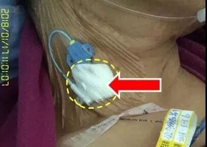 bd留置针怎么使用留置针固定多图详解：必须要U型吗，怎么固定才最合适？_https://www.jmylbn.com_新闻资讯_第17张