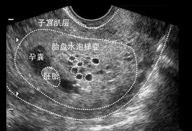 流產的超聲診斷 Haoyisheng 微文庫