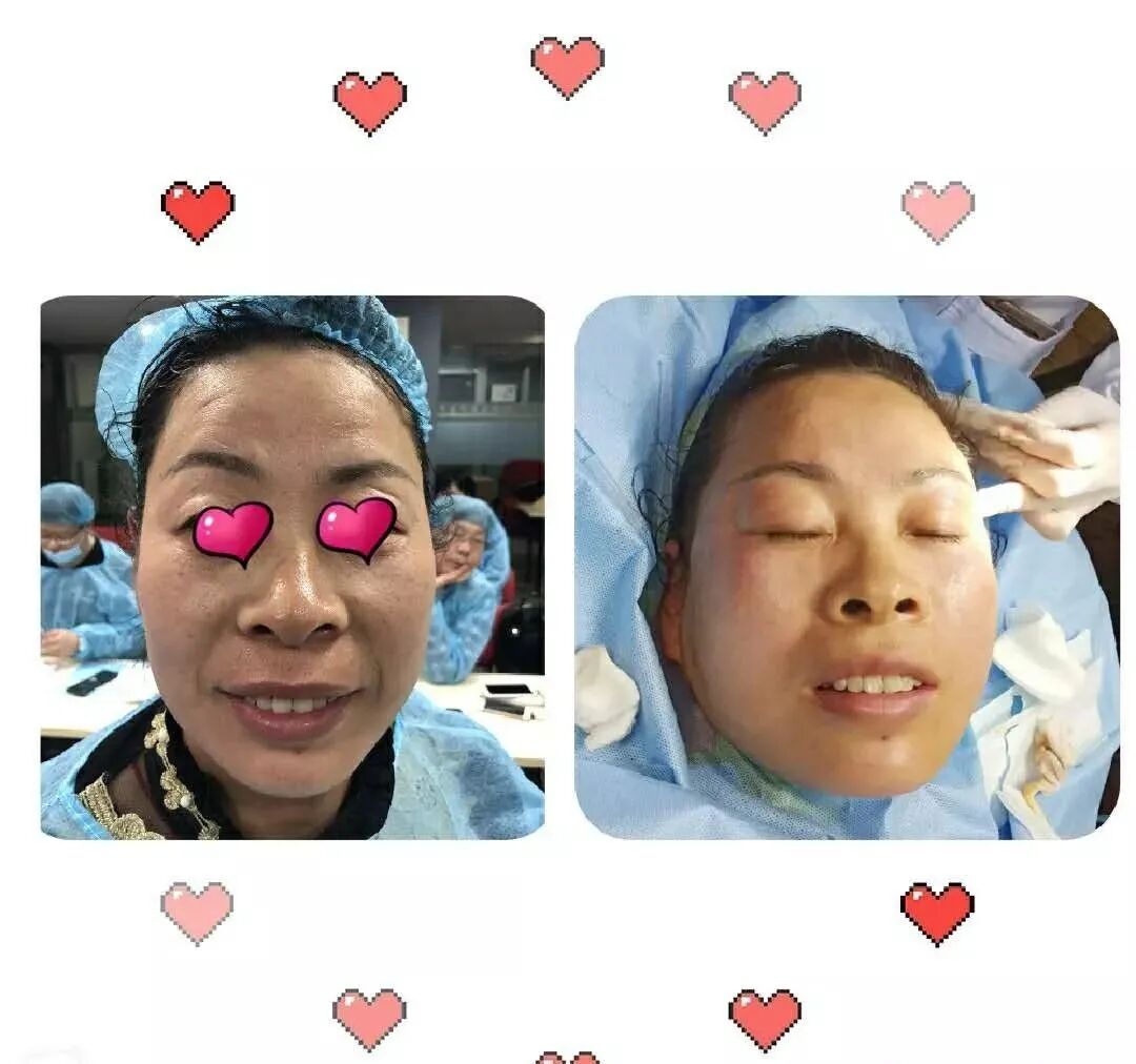 pga和pgla有什么区别早读 ｜ 线雕干货！5大角度深度讲解_https://www.jmylbn.com_新闻资讯_第23张