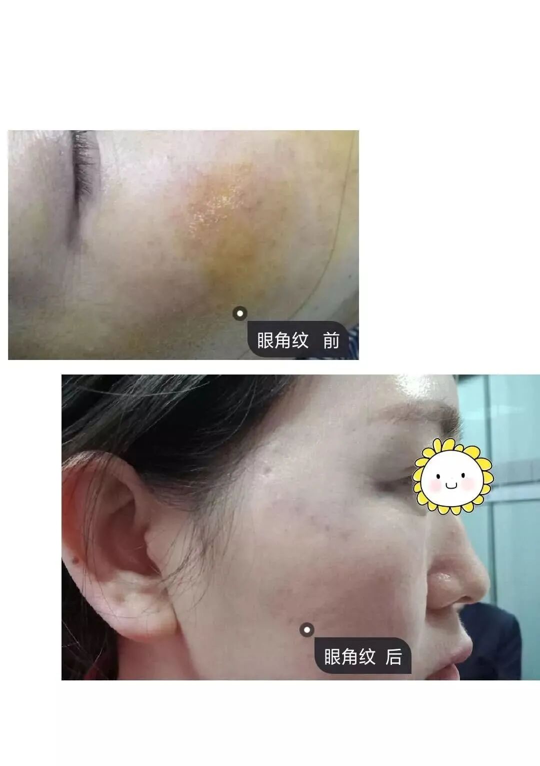 pga和pgla有什么区别早读 ｜ 线雕干货！5大角度深度讲解_https://www.jmylbn.com_新闻资讯_第21张