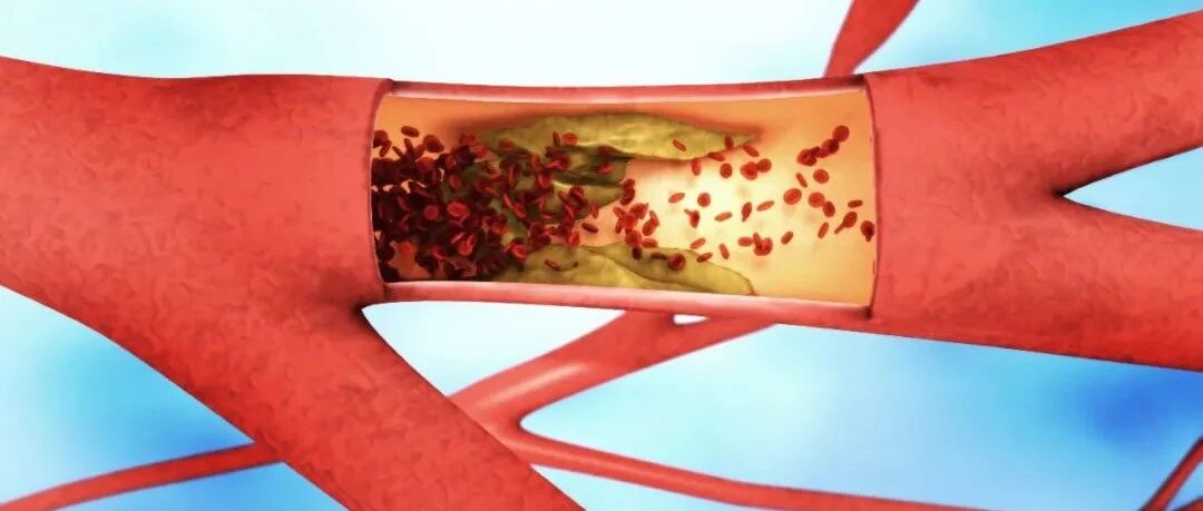 哪些人易出现动脉硬化呢?大多有这几个共性