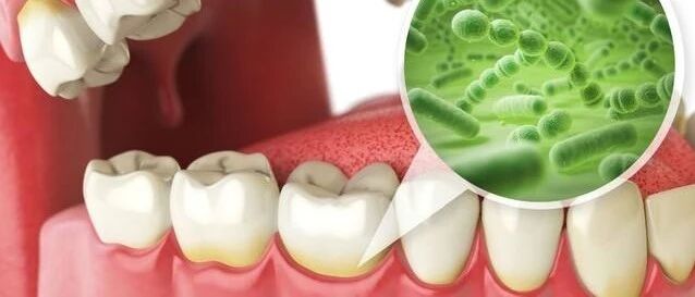 口腔细菌竟引起严重的心脏疾病？谨慎“病从口入”