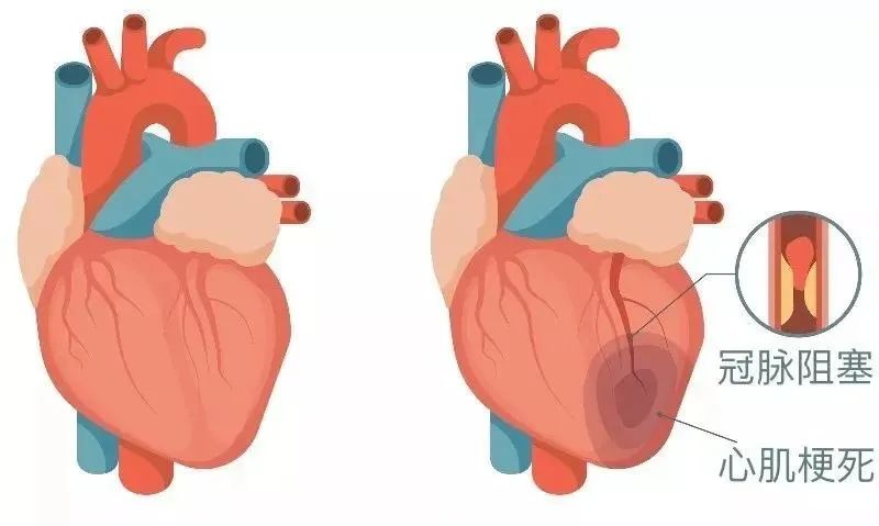 心肌梗死為什麼可怕？應該如何預防？ 健康 第1張