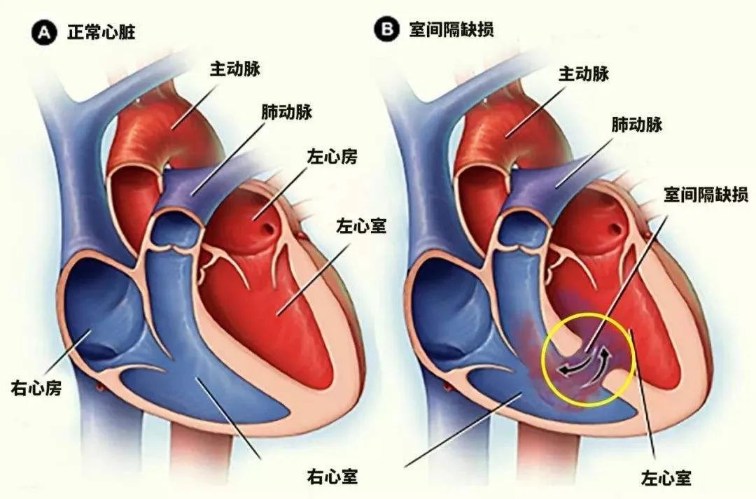 什麼是先天性心臟病室間隔缺損？ 健康 第4張