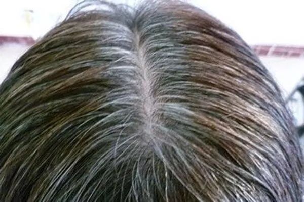 三大白发易发人群，看看有你吗？