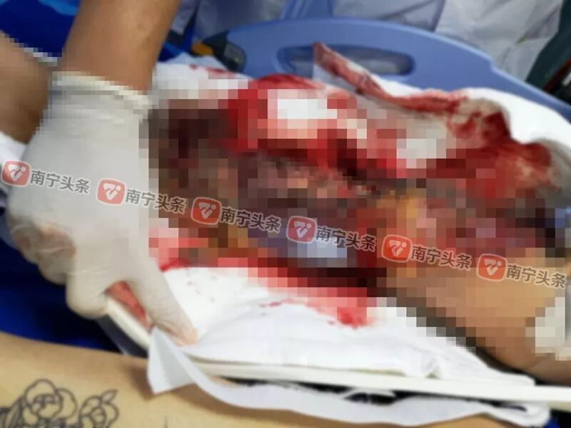 南宁两名女初中生被卷入泥头车 遭车轮多次碾压