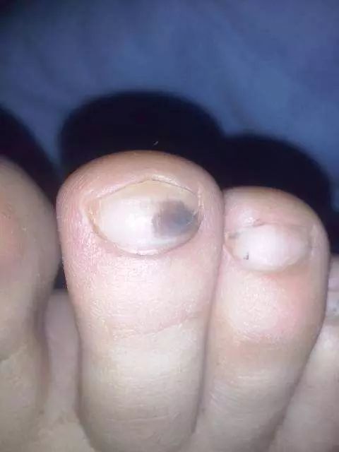 担心指(趾)甲变黑是黑色素瘤,而过度恐慌,其实是什么样子呢?