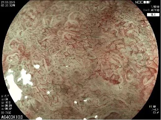 富士胃镜英文怎么写【新镜界】高清“电子眼”让胃肠病变“无处遁形”_https://www.jmylbn.com_新闻资讯_第7张