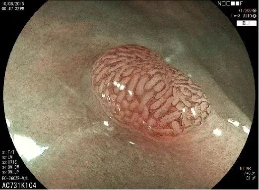 富士胃镜英文怎么写【新镜界】高清“电子眼”让胃肠病变“无处遁形”_https://www.jmylbn.com_新闻资讯_第5张