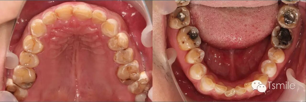 转载│前牙重度磨耗的病因分析