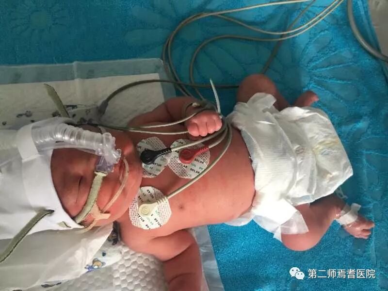 epap什么模式无创呼吸机（二）_https://www.jmylbn.com_新闻资讯_第64张