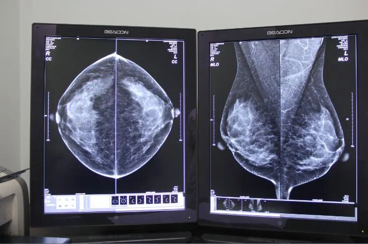 乳腺dr能检查什么【围观】乳腺有包块、疼痛、肿胀？可能要……_https://www.jmylbn.com_新闻资讯_第2张