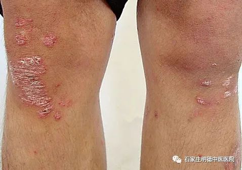 牛皮癬專科治療醫院牛皮癬怎么治療