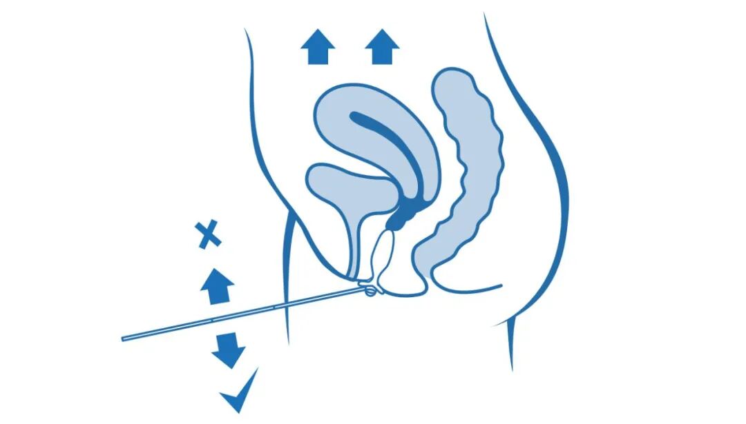 康复仪探头怎么拿一文读懂，如何正确使用盆底肌肉康复器_https://www.jmylbn.com_新闻资讯_第11张
