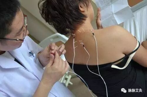 2 电针 周英采用电针配合刺络拔罐治疗局限性硬皮病患者52例,愈显率