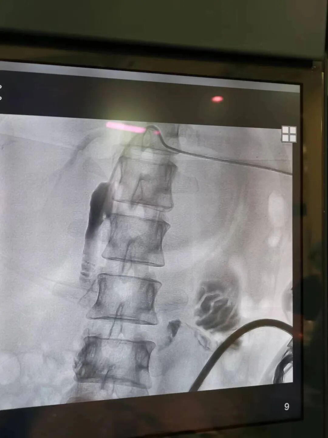 病例分享胆肠吻合口狭窄并肝内胆管结石的微创治疗