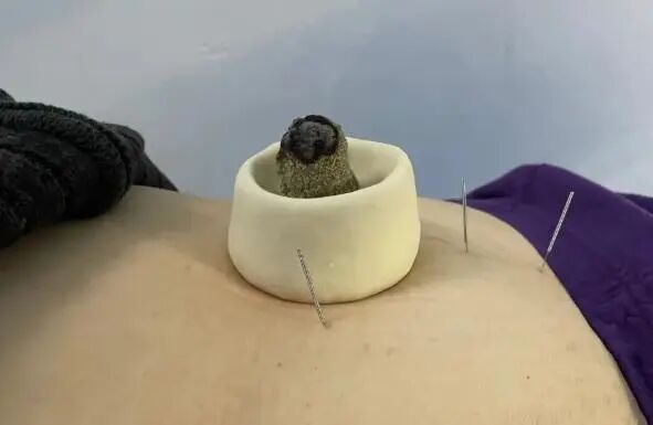 脐通百脉主治百病中医特色治疗脐灸