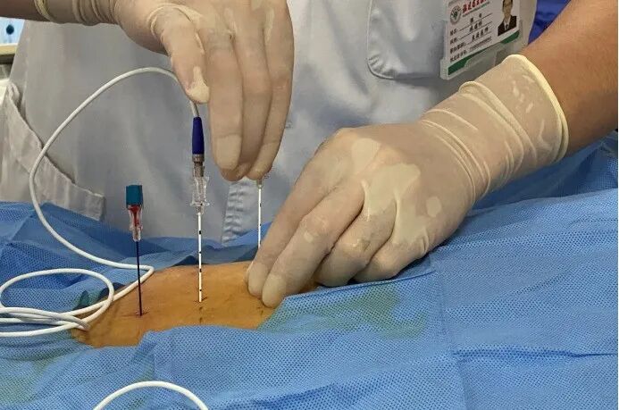 射频什么科【图文解析】疼痛科常用的射频治疗是什么疗法？可以治疗什么疾病？_https://www.jmylbn.com_新闻资讯_第7张