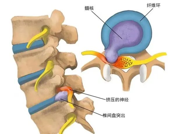 射频什么科【图文解析】疼痛科常用的射频治疗是什么疗法？可以治疗什么疾病？_https://www.jmylbn.com_新闻资讯_第14张
