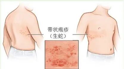 射频什么科【图文解析】疼痛科常用的射频治疗是什么疗法？可以治疗什么疾病？_https://www.jmylbn.com_新闻资讯_第12张