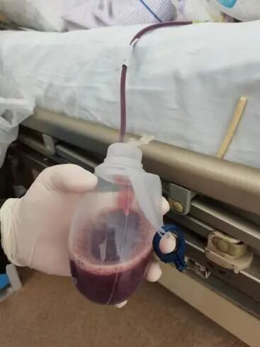 为什么负压引流【科普天地】：术后为什么要放置引流管，你知道吗？_https://www.jmylbn.com_新闻资讯_第29张