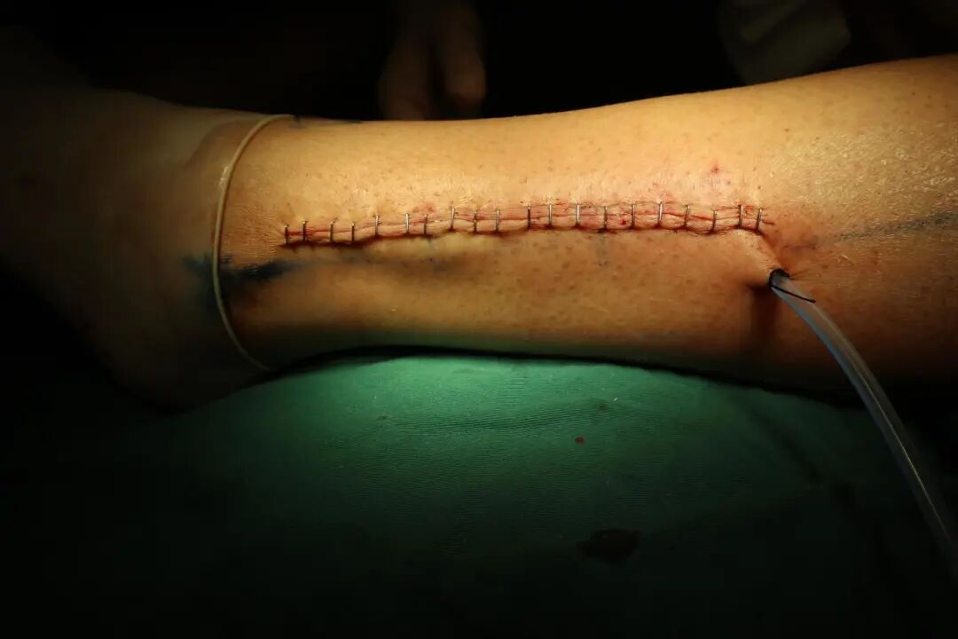 为什么负压引流【科普天地】：术后为什么要放置引流管，你知道吗？_https://www.jmylbn.com_新闻资讯_第11张