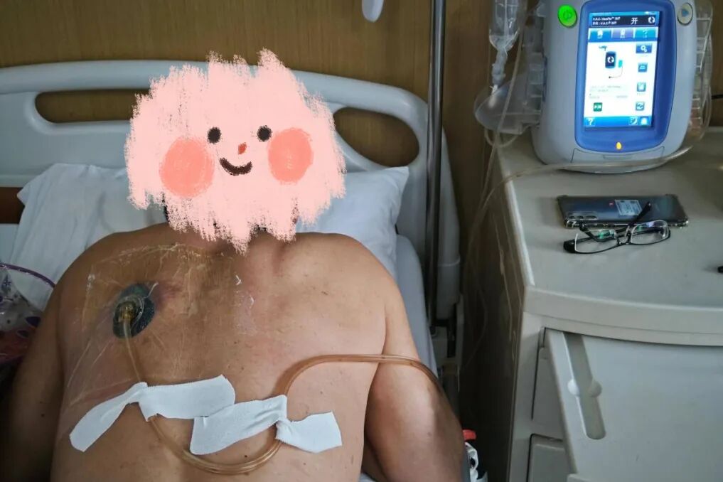 vsd引流器怎么连接田医生的外科笔记 ｜ 伤口愈合的“黑科技”：一文读懂负压封闭引流（VSD）_https://www.jmylbn.com_新闻资讯_第11张