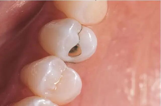 梦见掉了一颗虫牙，揭示内心深处的焦虑与自我审视