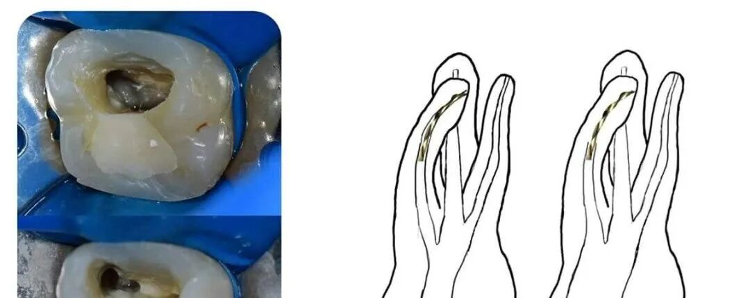 口腔H锉怎么消毒口腔精读 ｜ 根管器械折断如何处理？6种方法教你解决！_https://www.jmylbn.com_新闻资讯_第2张