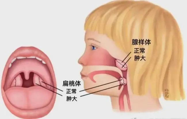 孩子打呼嚕,張口呼吸,竟是扁桃體腺樣體肥大惹得禍? - 駐馬店廣濟醫院