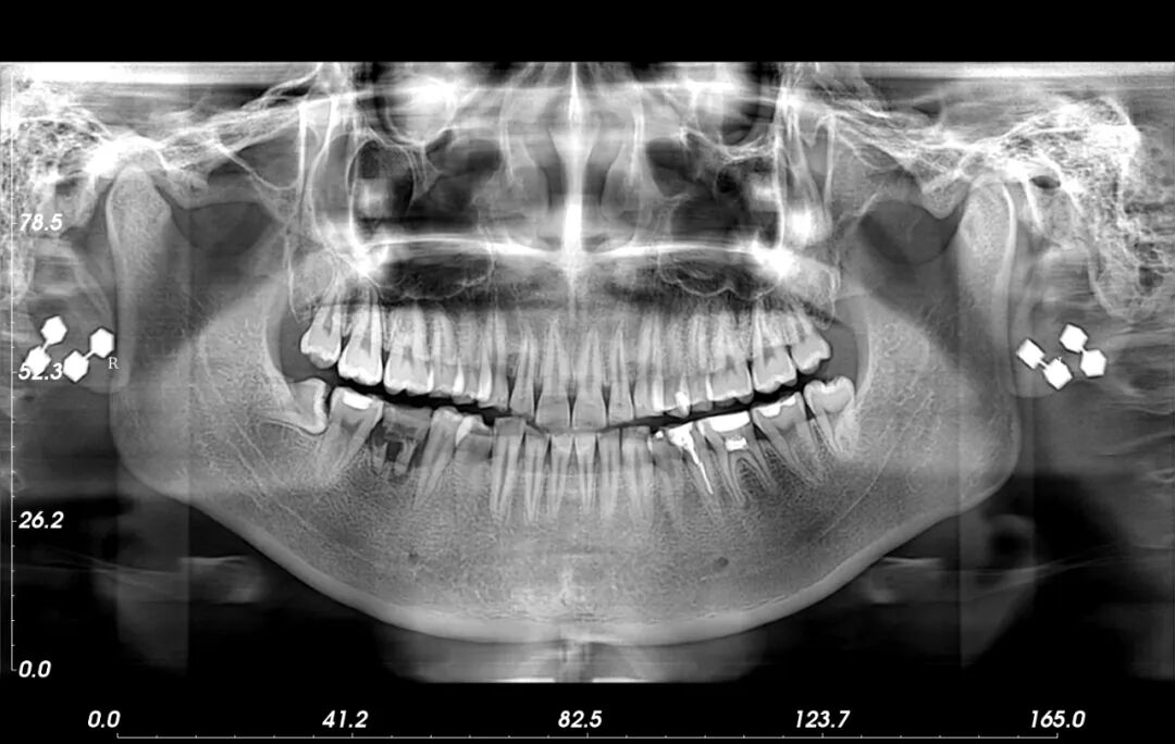 什么牌子口腔ct最好【口腔CT】直观、清晰、价格低廉、可刷医保，这CT“简直”了！_https://www.jmylbn.com_新闻资讯_第6张