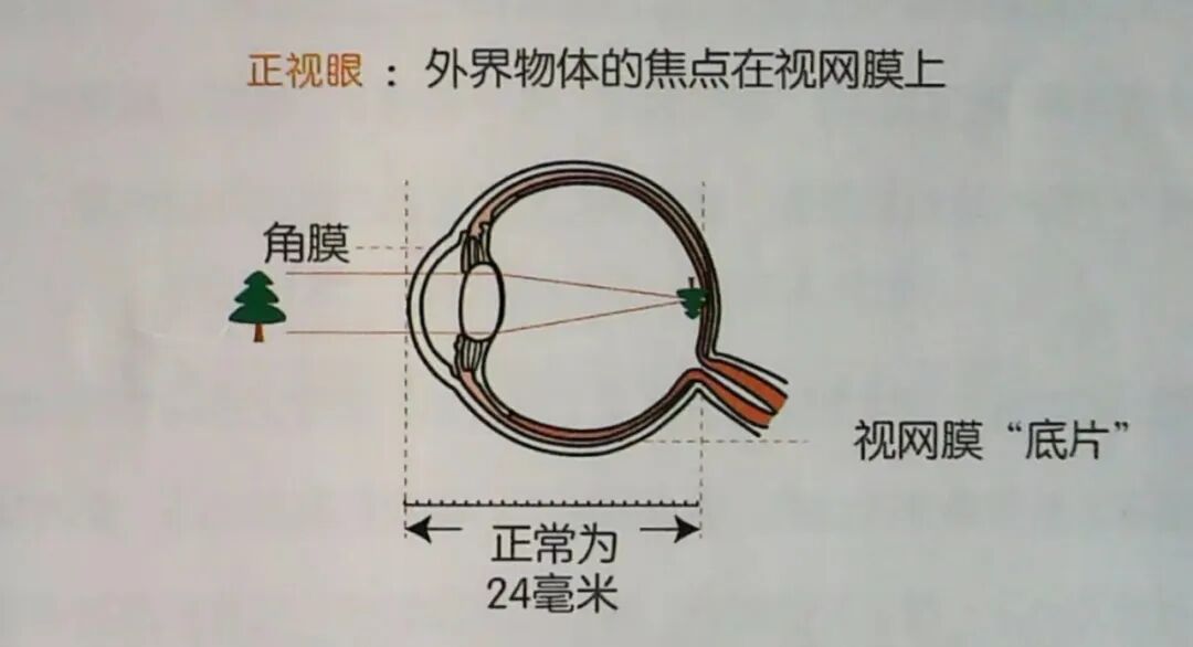 儿童保健电脑怎么用卫生保健：呵护明眸 ‘睛’彩一生（二）——儿童近视早发现_https://www.jmylbn.com_新闻资讯_第7张