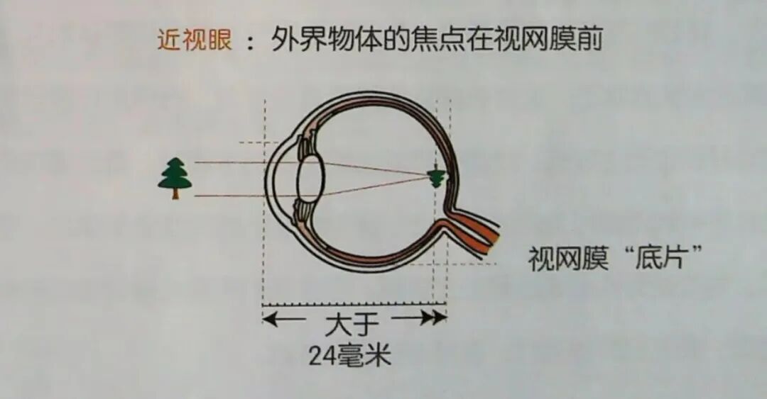 儿童保健电脑怎么用卫生保健：呵护明眸 ‘睛’彩一生（二）——儿童近视早发现_https://www.jmylbn.com_新闻资讯_第8张