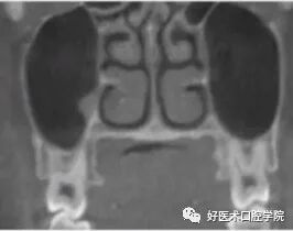 一文读懂与上颌窦提升术相关的上颌窦囊性病变！